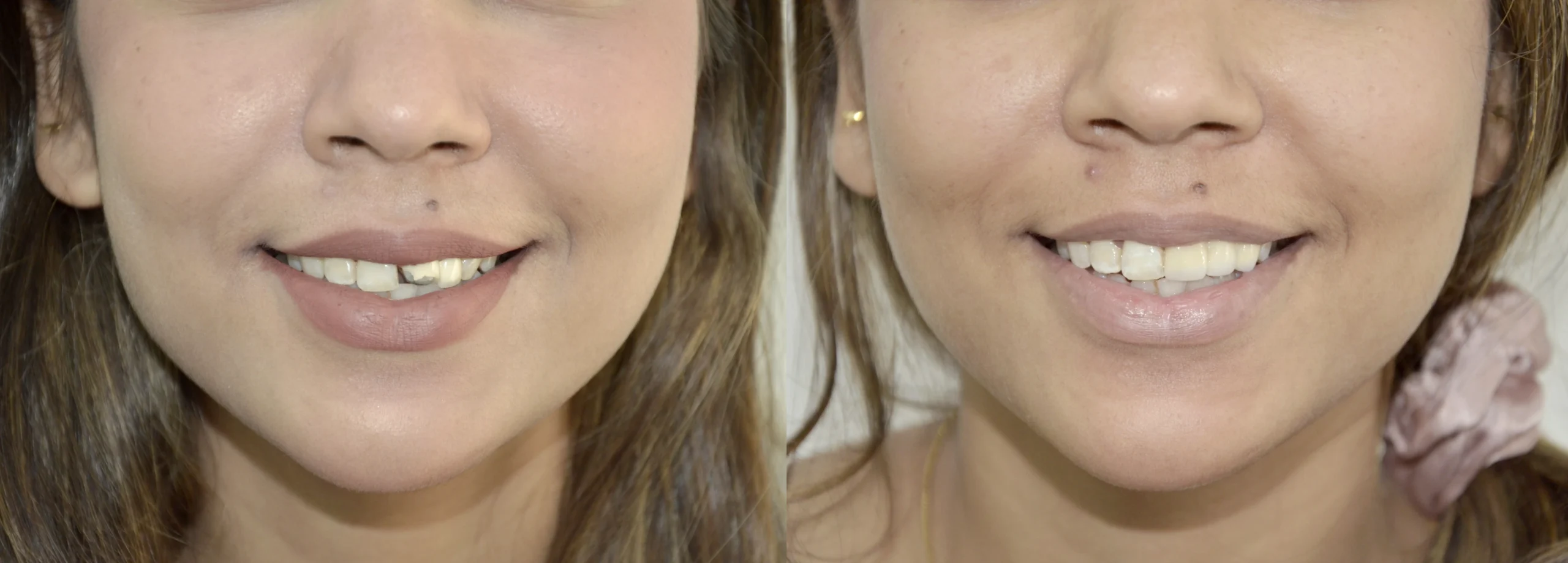 before after 1