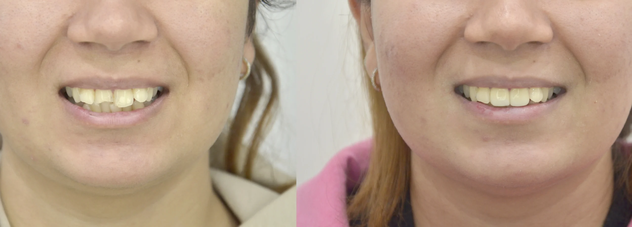 before after 11