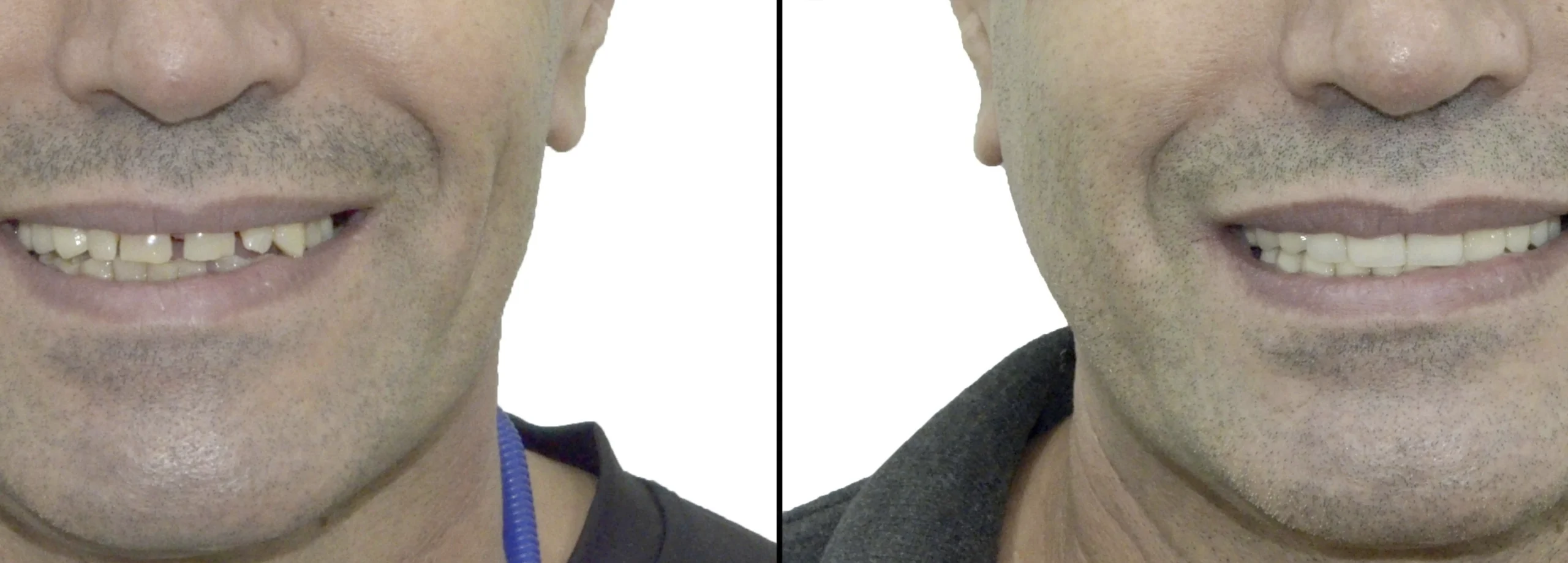 before after 13