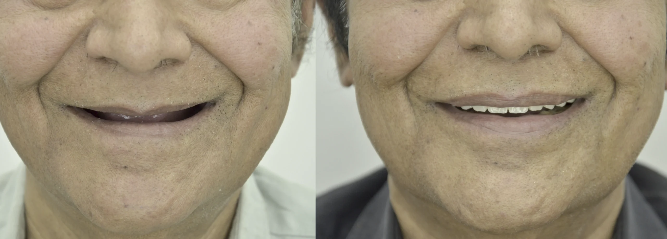 before after 14