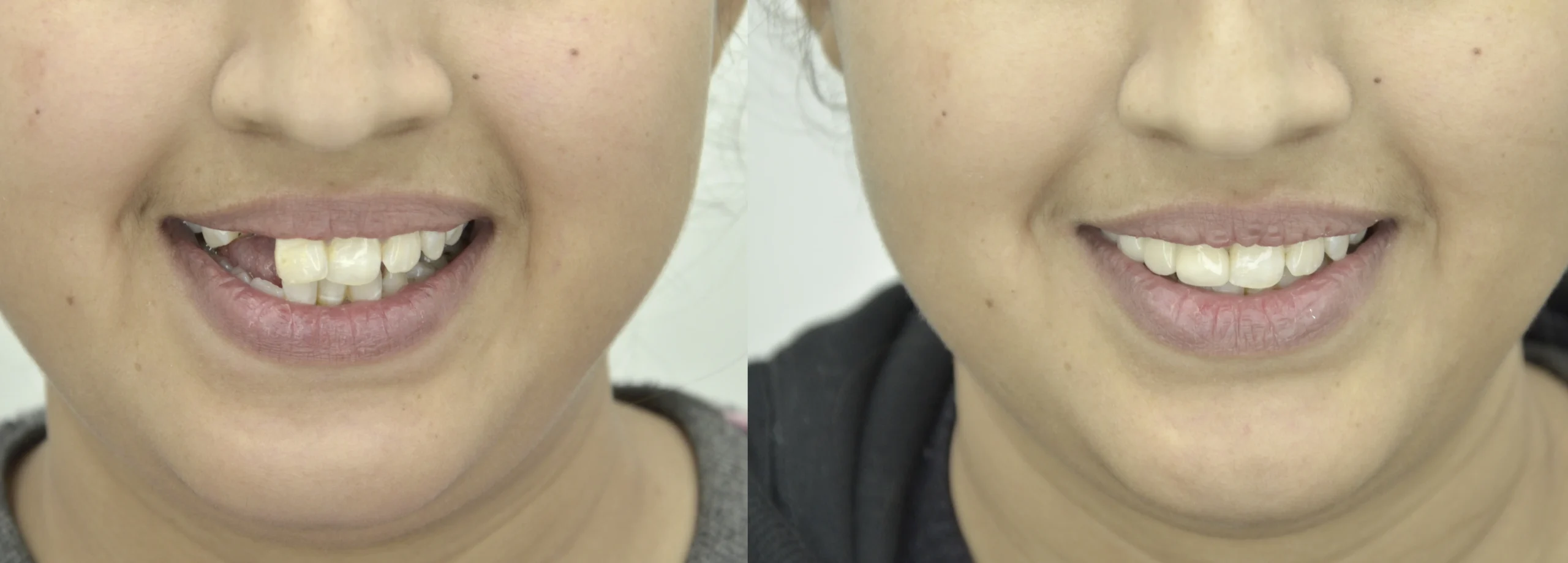 before after 4