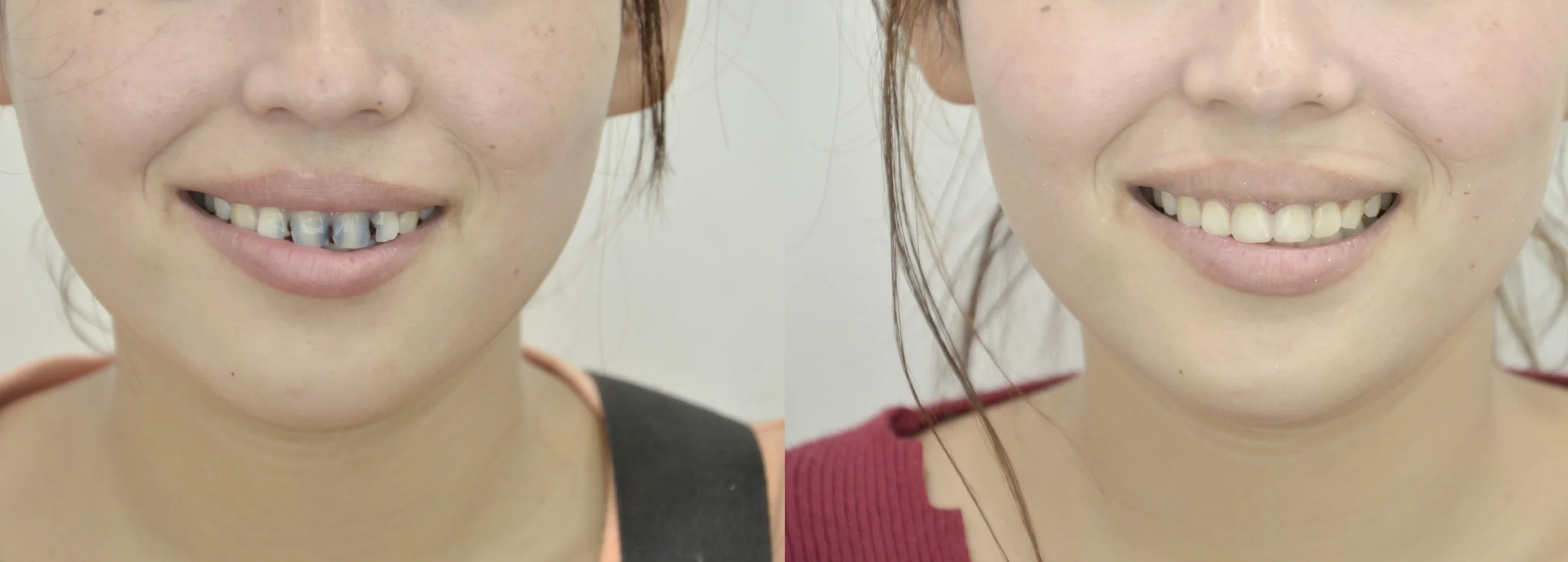 before after 5